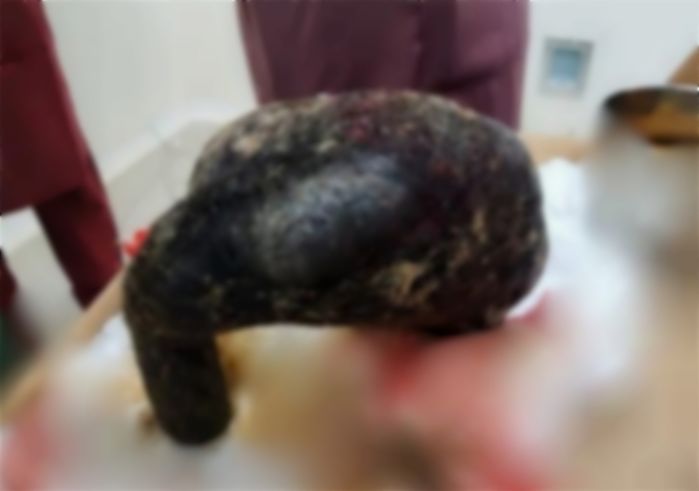 4년 동안 ‘이것’ 먹은 20대 여성... 위에서 나온 ‘큰 돌덩어리’ 충격