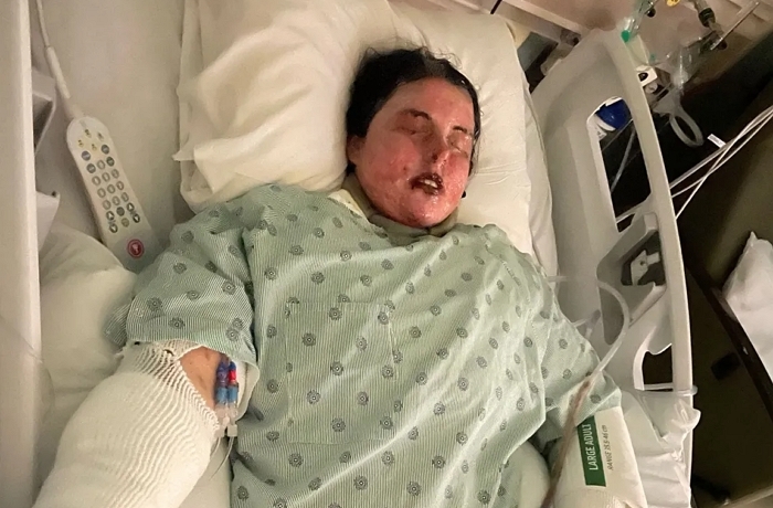 “의사가 처방한 약 먹었는데”... 전신 피부 87% 잃고 ‘실명’한 여성