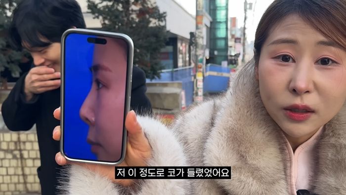 ‘서준맘’ 박세미, 15년 전 코 성형 재수술 고백... “부작용으로 구축 생겨, 갈비뼈 이식”