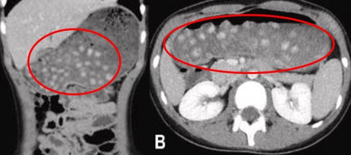 복통 호소한 10세 女 위에 가득 찬 덩어리 정체... ‘이 음료’가 원인이었다
