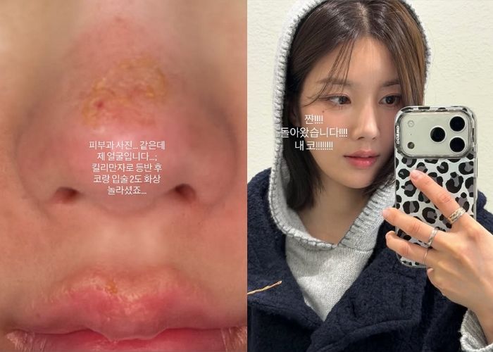 권은비, 킬리만자로 등반 후 얼굴 2도 화상... “기미 생기고 붉어져”