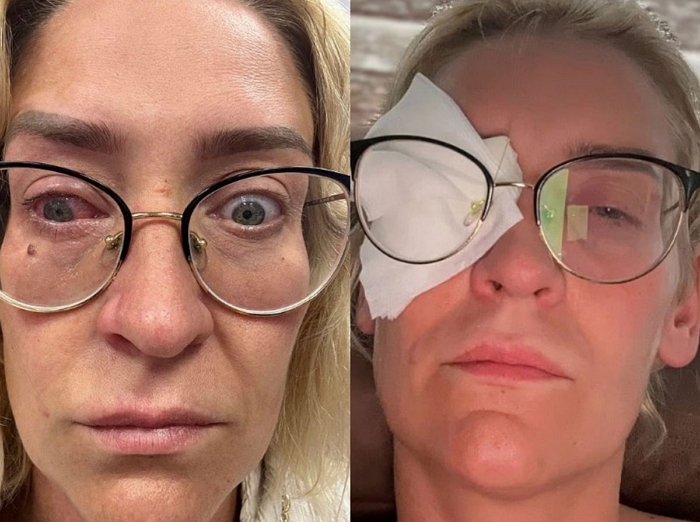 “귀찮아서 2주간 렌즈 안 뺐는데”... 세균 감염으로 한쪽 눈 실명한 30대 간호사