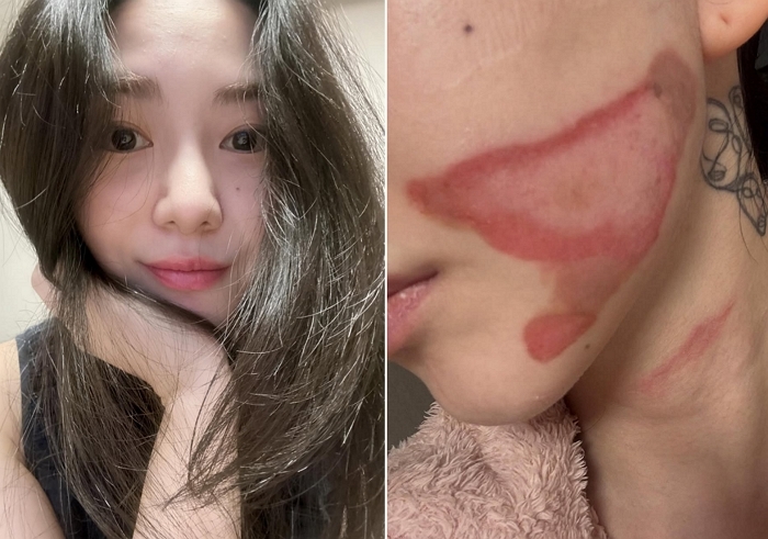 “얼굴 10%가 2도 화상”... 권민아가 시술받다 날벼락 맞고 공개한 충격적인 현재 상태