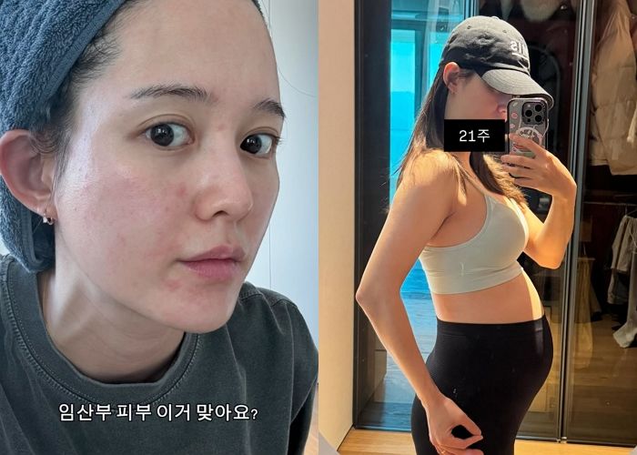 남보라, ‘임신 21주차’ 피부 트러블 고백 “이거 맞아요?”