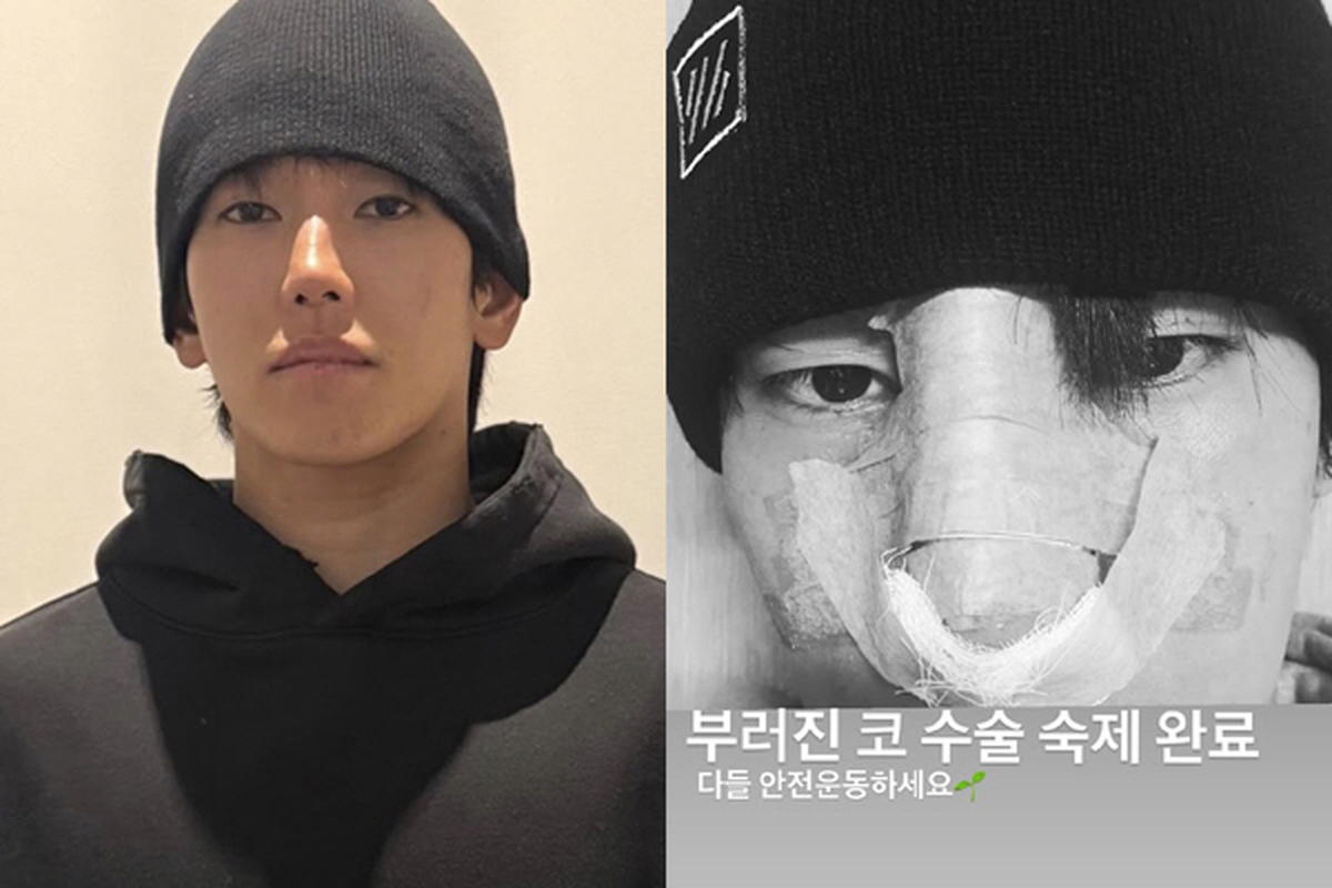 복싱하다 다친 육준서, 결국 '코 수술' 받았다... 어떻게 변했나