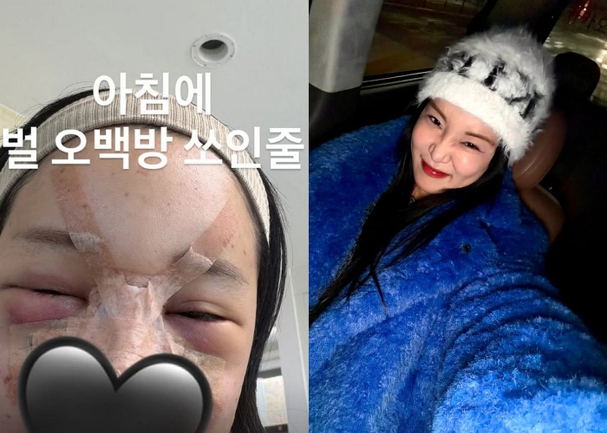 랄랄, 설 연휴 성형수술 솔직 후기... “벌 500방 쏘인 줄”