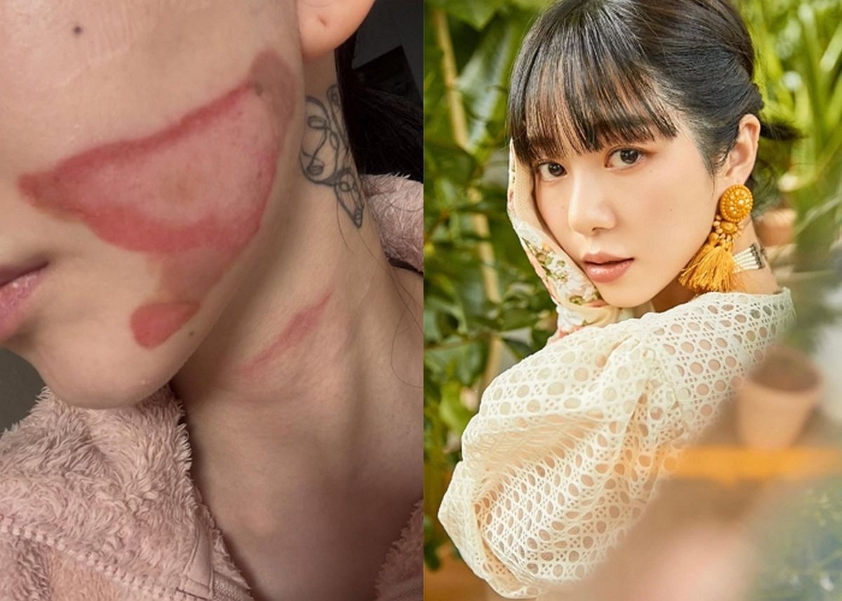 권민아, ‘피부 시술 부작용’ 2도 화상에 고통 호소... “30년째 벌 받는 기분”