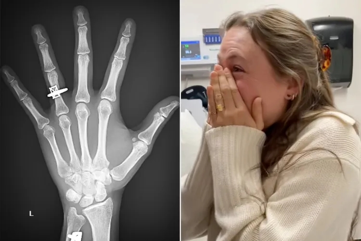 다친 손목 엑스레이 찍었더니 내 손엔 없는 '반지'가?... 의사 실수인 줄 알았더니 '반전' (영상)