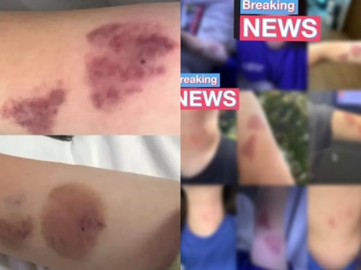 지난해 6월 하츠투하츠 경호원에게 폭행을 당한 A씨가 게시한 피해 사진 [X 캡처]