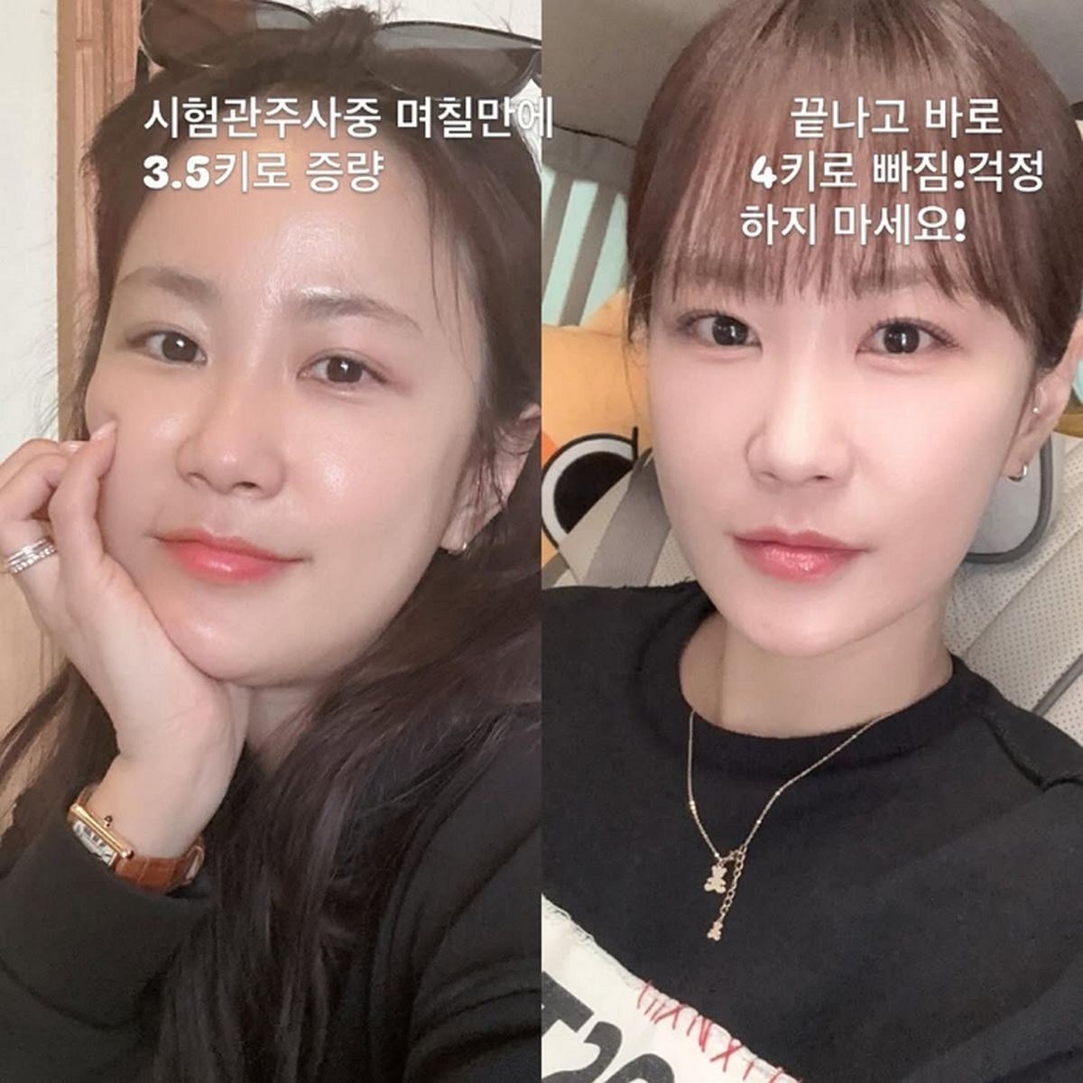 ‘김준호♥’ 김지민, 시험관 주사에 변한 얼굴 “3.5kg쪘다 바로 빠져”