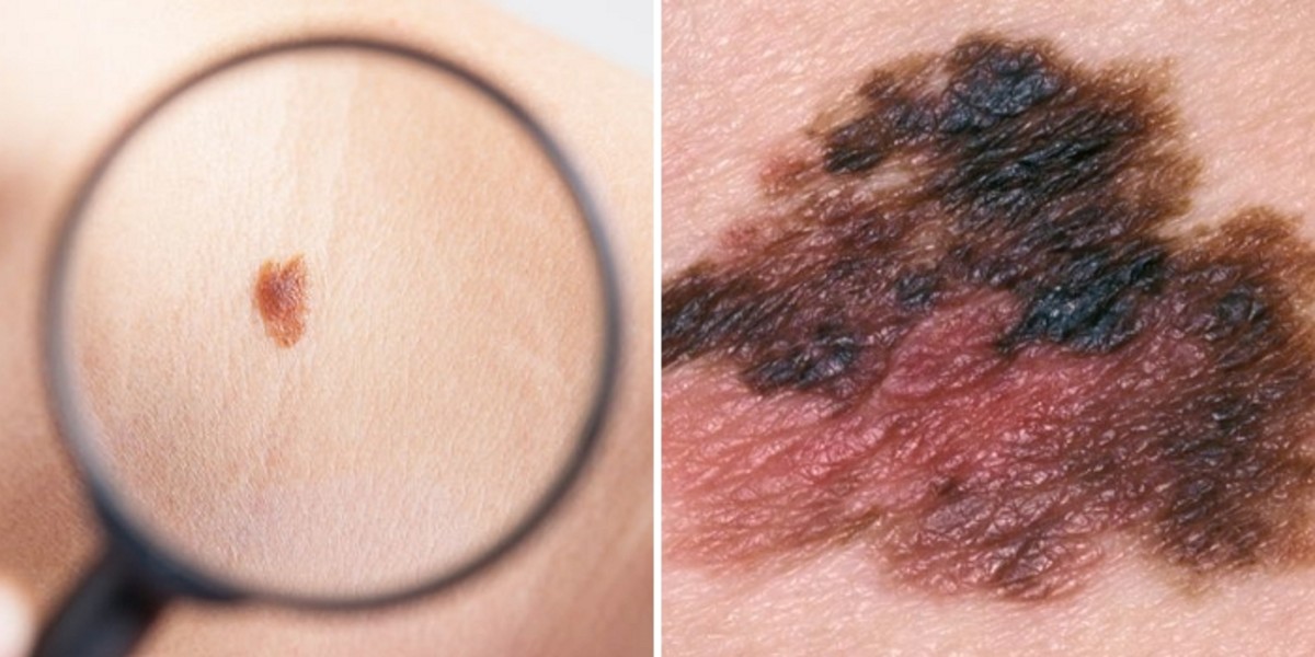 “점인 줄 알았는데 암” 25세 예비신부 목숨 앗아간 ‘암왕’의 정체