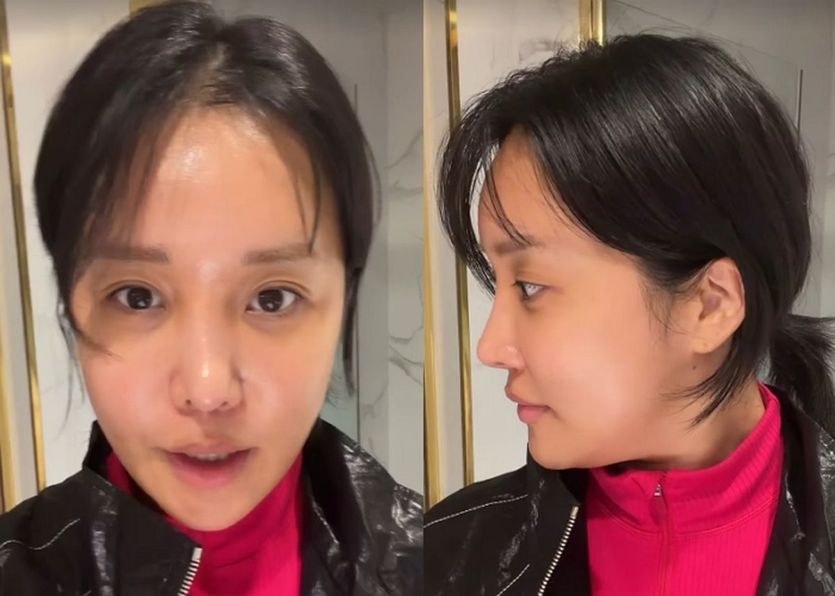 랄랄, 코 재수술·눈밑지 시술 후 ‘부작용’ 토로... 솔직 후기 눈길