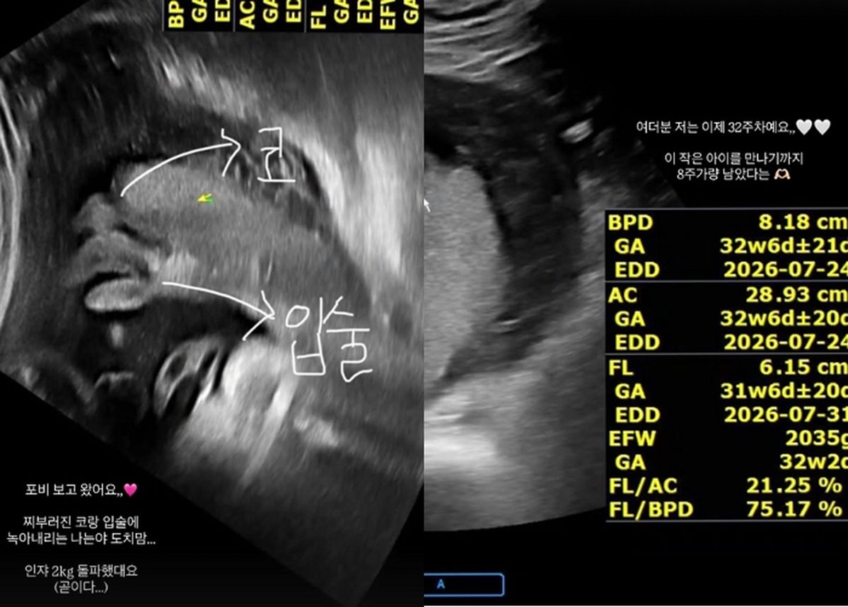 “곧 엄마 된다” 하트시그널4 김지영, 임신 32주차 초음파 사진 공개