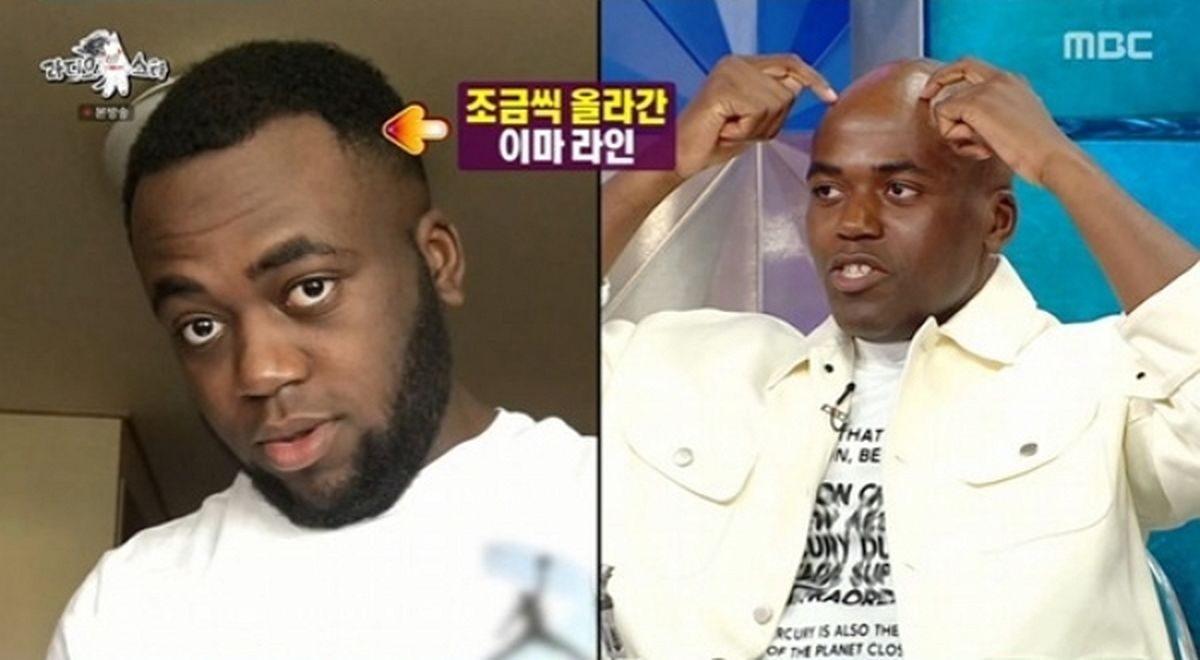 조나단, 아직 20대인데 탈모... “미세한 바람까지 두피로 느껴”