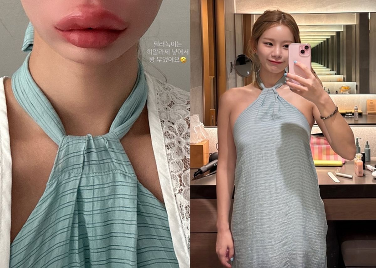 맹승지, 입술 필러 제거하고 퉁퉁 부었다... “과유불급, 내 얼굴 아니더라”