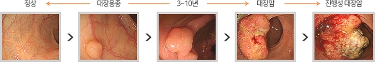 대장암의 단계적 생성 및 진행 과정 / 대한위대장내시경학회